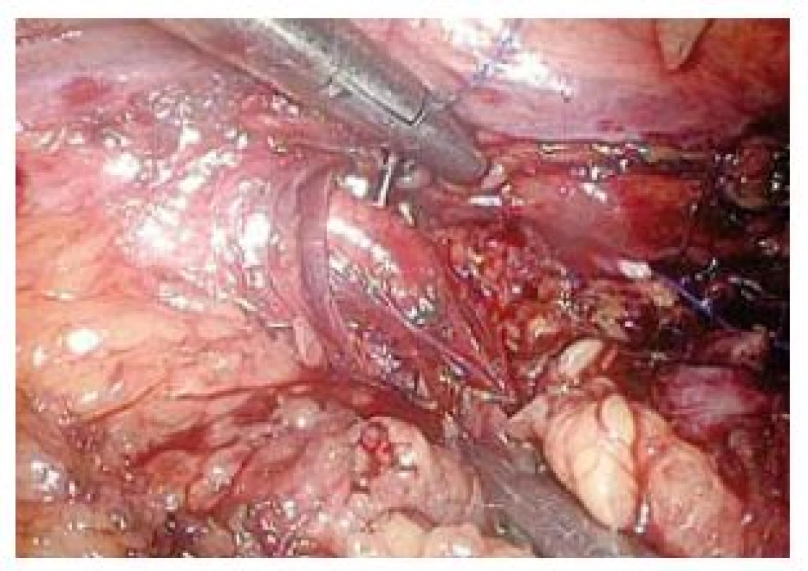 Třetí steh nakládaný do m. quadratus lumborum
Fig. 6. The third stitch digged in m. quadratus lumborum