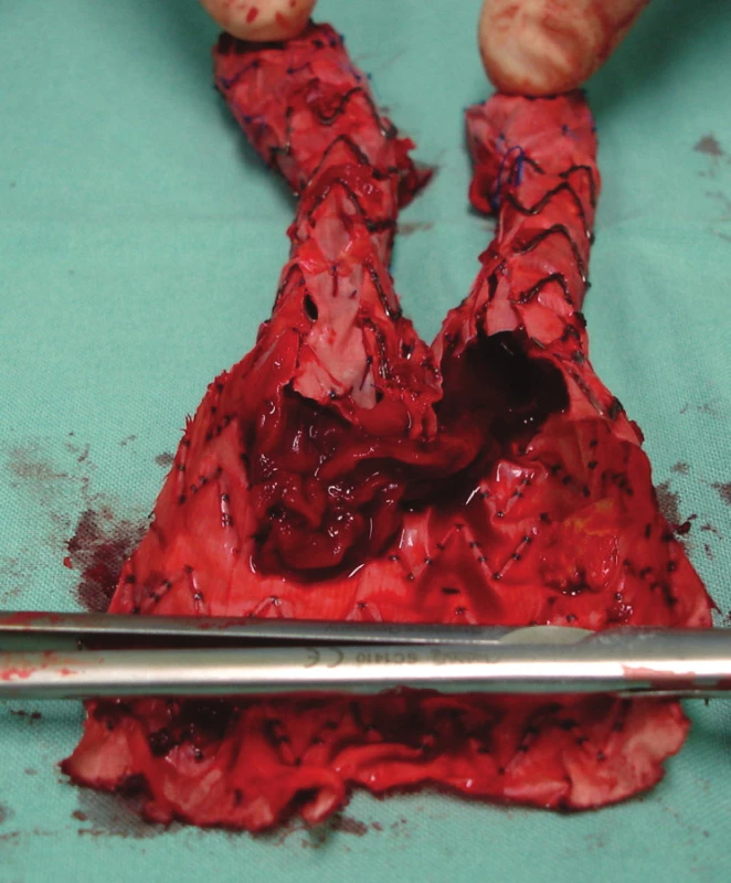 Nástěnný trombus uvnitř stentgraftu
Fig. 17: Wall thrombus within the stentgraft