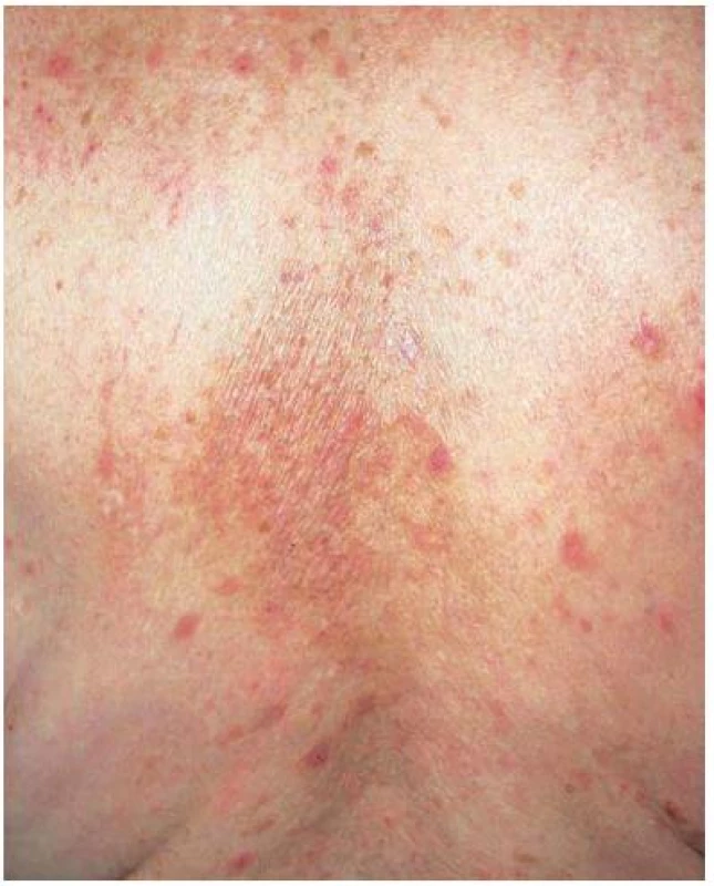 Notalgia paresthetica