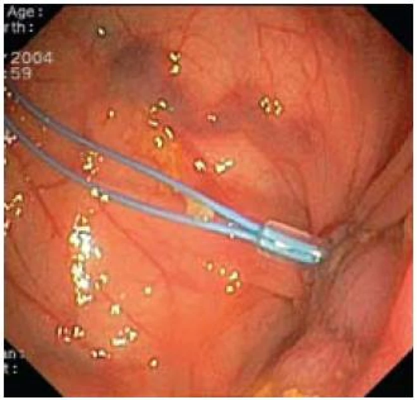 Endoloop.
Fig. 1. Endoloop.