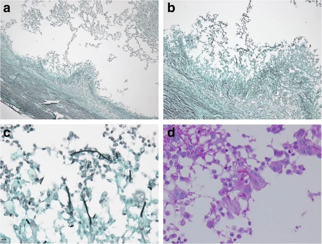 Histopathology of the surgical specimen show the hyaline, branching septate hyphae in multinucleated giant cells with surrounding neutrophils. (a–c) Grocott’s methenamine silver stain (×40, ×100, ×400) and (d) Periodic acid-Schiff stain (×400)
