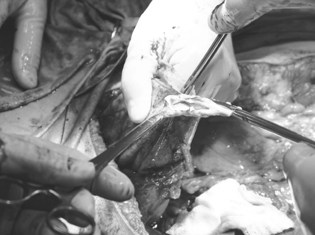 Otvorená cysta po odsatí obsahu
Pic. 5. The cyst opened, following aspiration of the contents