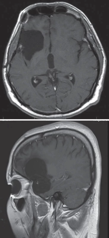 Inzulární gliomy.
Fig. 2. Insular gliomas.