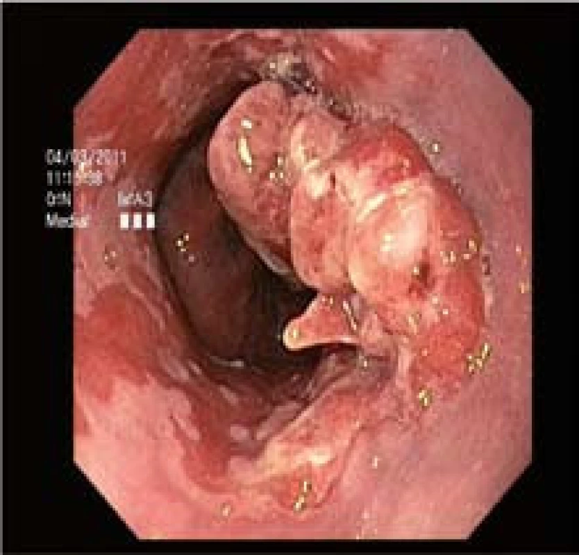 Původní makroskopický vzhled komplexní léze v terénu Barrettova jícnu.
Fig. 1. The initial complex lesion in Barrett’s esophagus.
