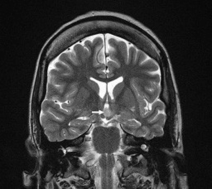 Hypotalamický hamartom, intrahypotalamický typ. T2 TSE sekvence, koronární řez.