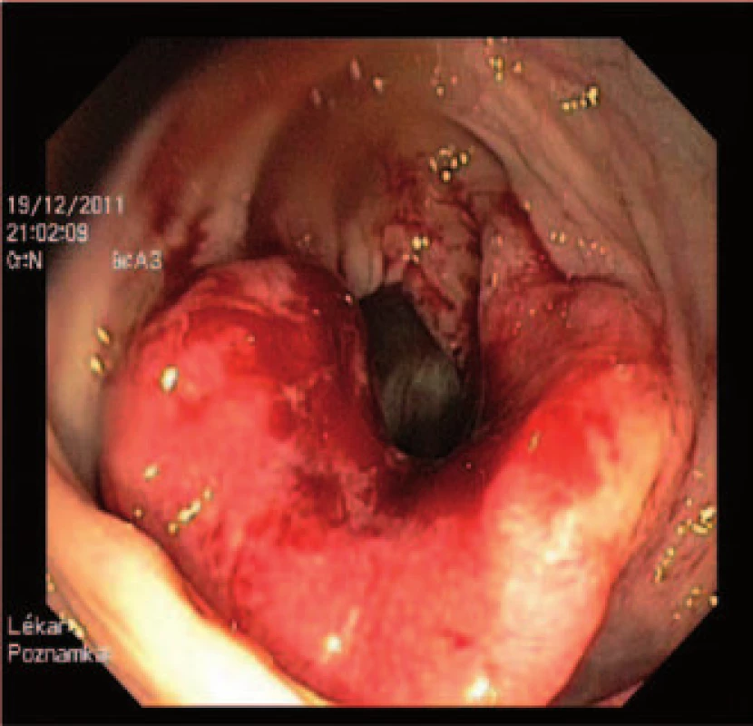 Porovnání nálezů na kolonické kapsli a optické kolonoskopii (a, b – polyp, c, d – karcinom). Zdroj: archiv Oddělení gastrointestinální endoskopie v ÚVN.
Fig. 2. Comparison of lesions found on capsule endoscopy and optical colonoscopy (a, b – polyp, c, d – cancer). Source: Department of Gastrointestinal Endoscopy of Military University Hospital.