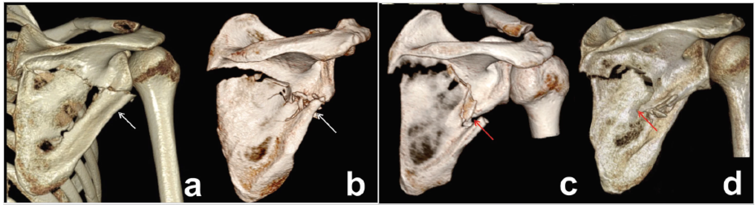 Types of two-part fractures of lateral pillar, different course of fracture line
a – immediately below to inferior glenoid rim; b – at the level of origin of triceps long head tendon; c – through circumflex notch; d – on the border between superior and inferior half of lateral pillar. White arrow – circumflex notch, red arrow – spike of superior fragment. Notice of different types of fragment displacement (translation versus angulation with fragment overlap).