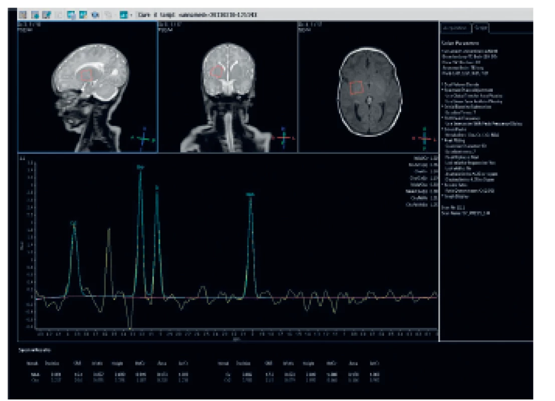 MR spektroskopie: patologicky zvýšený peak 3.56 ppm.
Fig. 5. MRI spectroscopy: pathologically high peak 3.56 ppm.