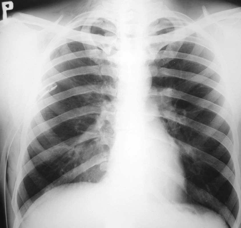 RTG hrudníka 5 dní po drenáži hrudníkovej dutiny, zobrazujúca ústup pľúcneho edému a pretrvávajúci PNO vpravo
Fig. 4. Thoracic x-ray 5 days following drainage of the thoracic cavity, depicting resolving pulmonary edema and persisting pneumothorax on the right