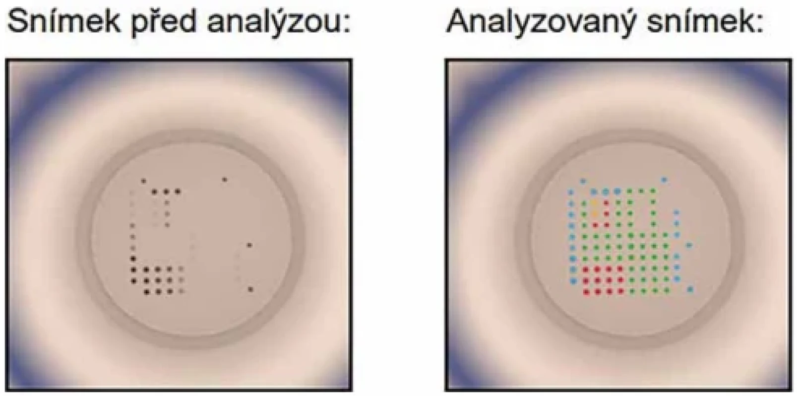 Analýza vzorku séra pacienta 4363 na Microblot-Array Borrelia IgG; pozitivní antigen VIsE, p83 a p17 (foto B. Macúchová, vlastní fotografie, Laboratoře AGEL a.s.) Figure 2. Analysis of a serum sample from patient 4363 using the Microblot-Array Borrelia IgG; positive for VlsE, p83, and p17 antigens (photo by B. Macúchová, original photograph, AGEL Laboratories, Inc.)