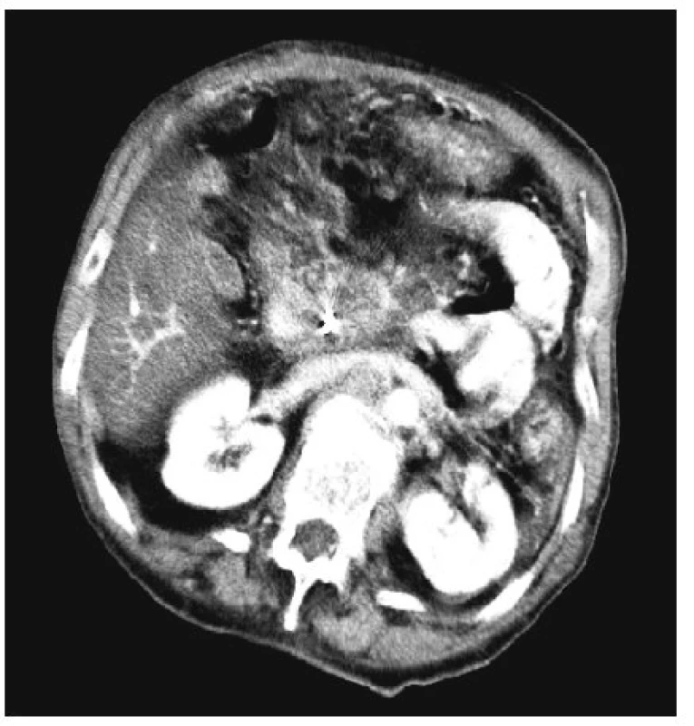 Tentýž tumor těla pankreatu 3 měsíce po RFA
Fig. 5. The same tumor of the pancreatic head 3 months after the RFA procedure