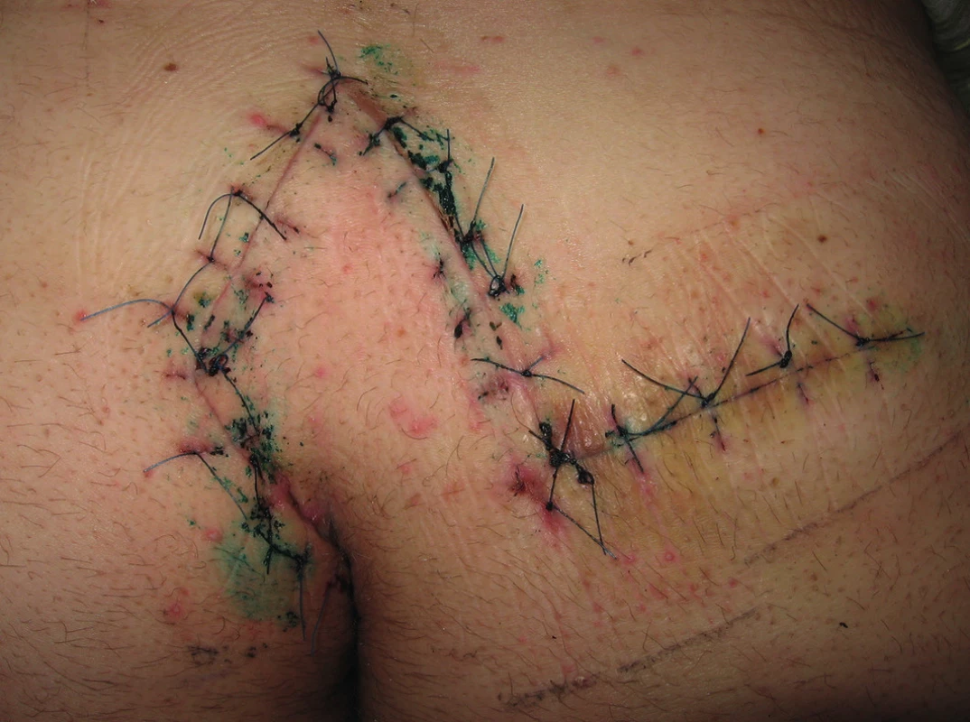 Výsledný vzhled operační rány
Fig. 5: Final appearance of surgical site