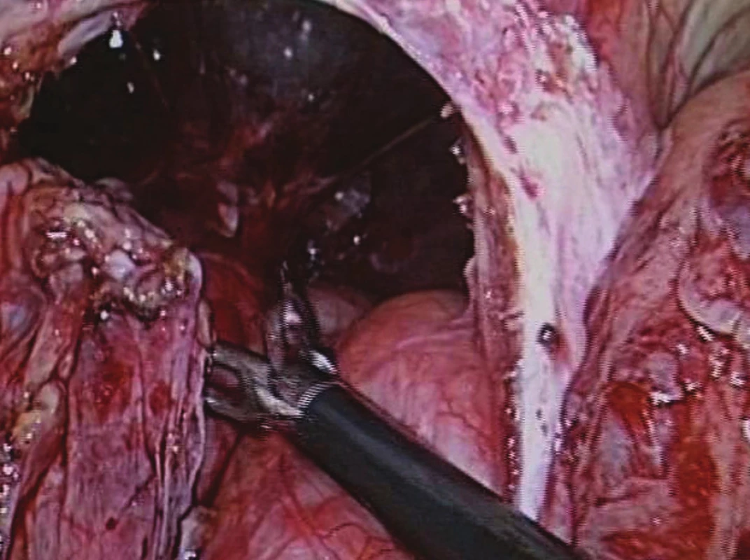 Resekce kýlního vaku – herniotomie
Fig. 15: Resection of the hernial sac – herniotomy