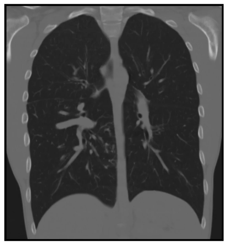 CT plic − koronální rekonstrukce v plicním okně:
dilatované plicní řečiště pravého dolního laloku<br>
Fig. 2: CT scan of the lungs, coronal reconstruction in the
pulmonary window: dilated pulmonary vasculature of
the right lower lobe