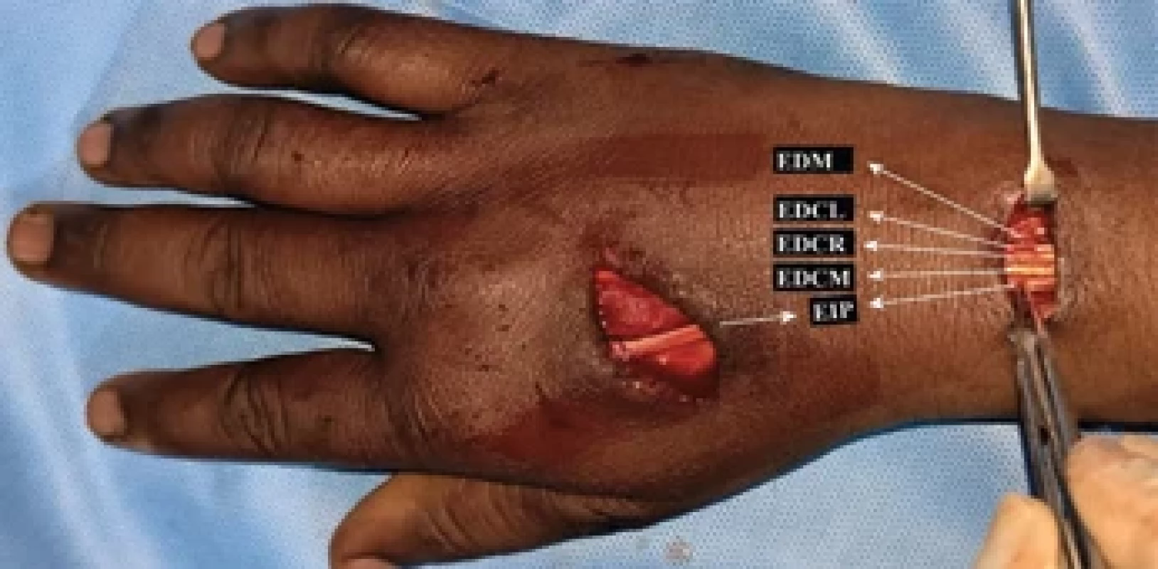  Right hand dorsum with absent extensor digitorum of index fi nger
