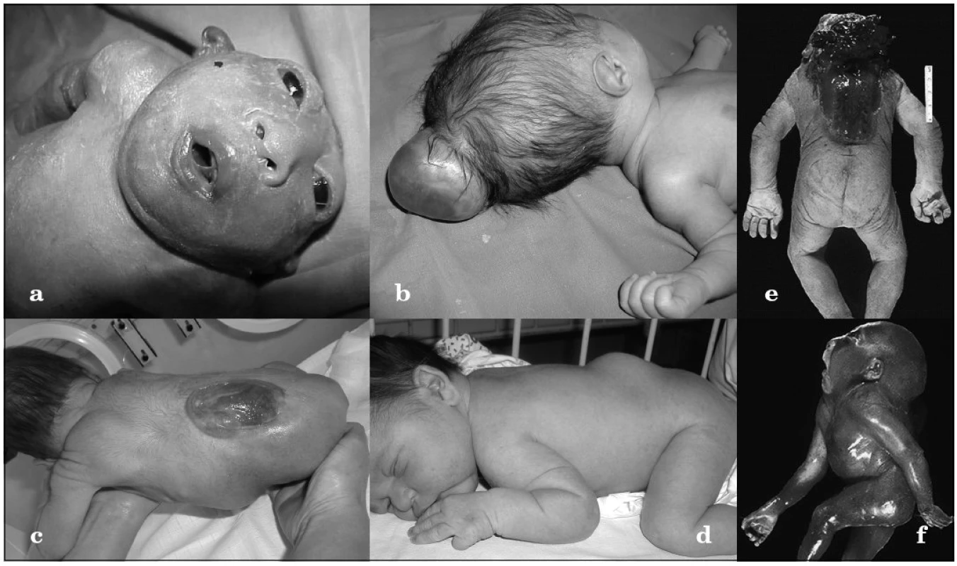 Formy rázštepov nervovej trubice.
a) anencefalus, b) encefalokéla, c) meningomyelokéla, d) meningokéla krytá kožou, e) craniorhachischisis, f) iniencephalus
Fig. 1. Forms of neural tube closure defect.
a) anencephalus, b) encephalocele, c) meningomyelocele, d) meningocele covered by skin e) craniorhachischisis, f) iniencephalus