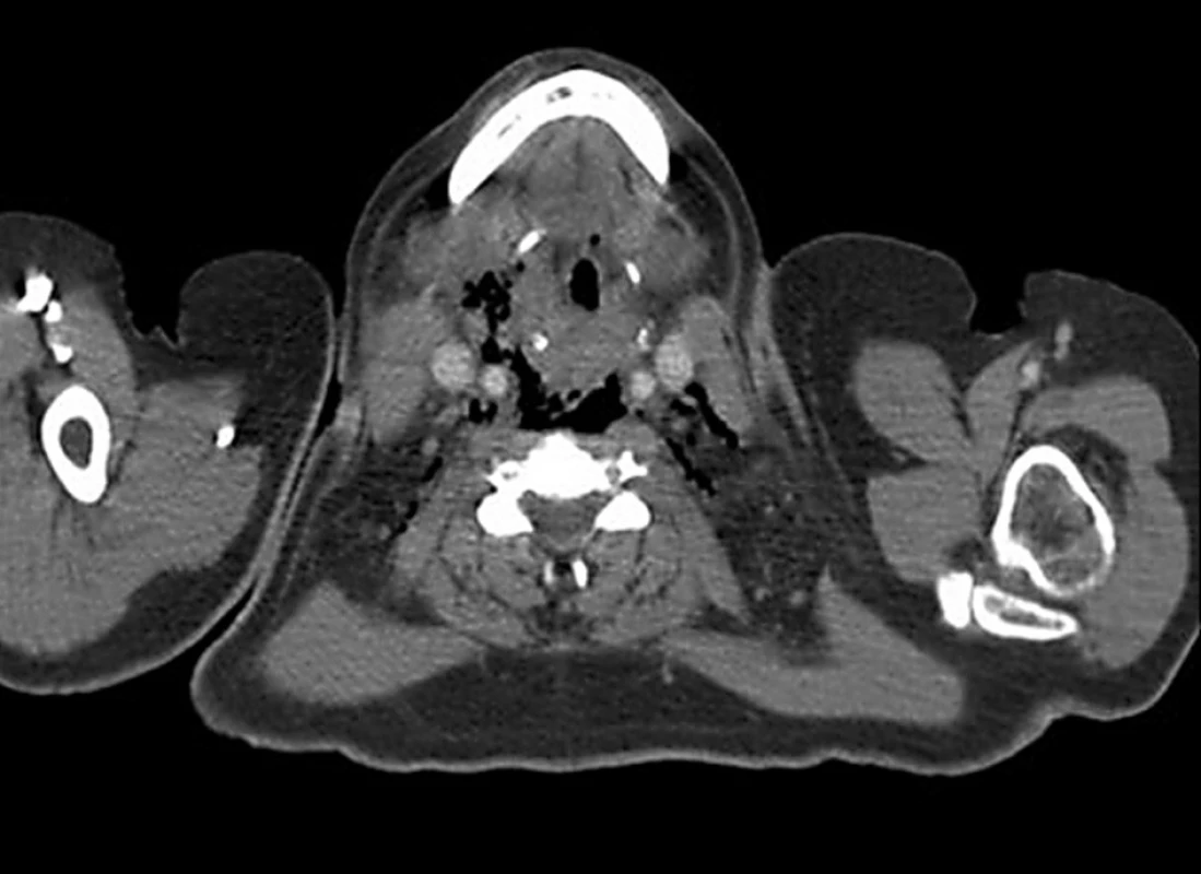 Bubliny plynu v prevertebrálním a perivaskulárním prostoru
Fig. 4. Gas bubbles within the prevertebral and perivascular space