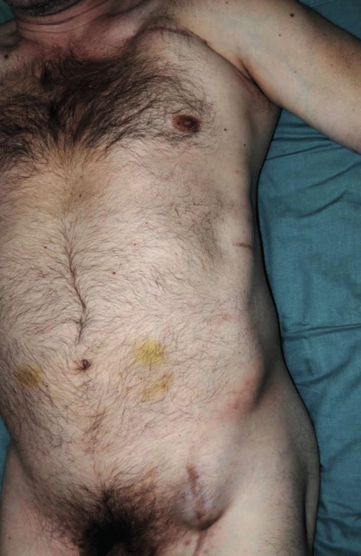 Perigraft seroma around left-sided axillofemoral bypass (lying position)