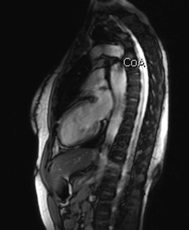 MRI hrudní aorty – koarktace aorty nově diagnostikovaná u 29leté pacientky před IVF (archiv autorů).
Fig. 6. MRI of thoracic aorta – coarctation of aorta diagnosed in a 29-year female patient before IVF (authors’ archive).