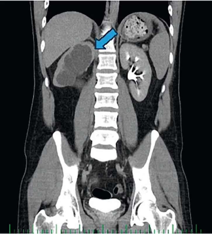 Afunkce pravé ledviny na CT urografii. Afunction of the right kidney on CT urography.