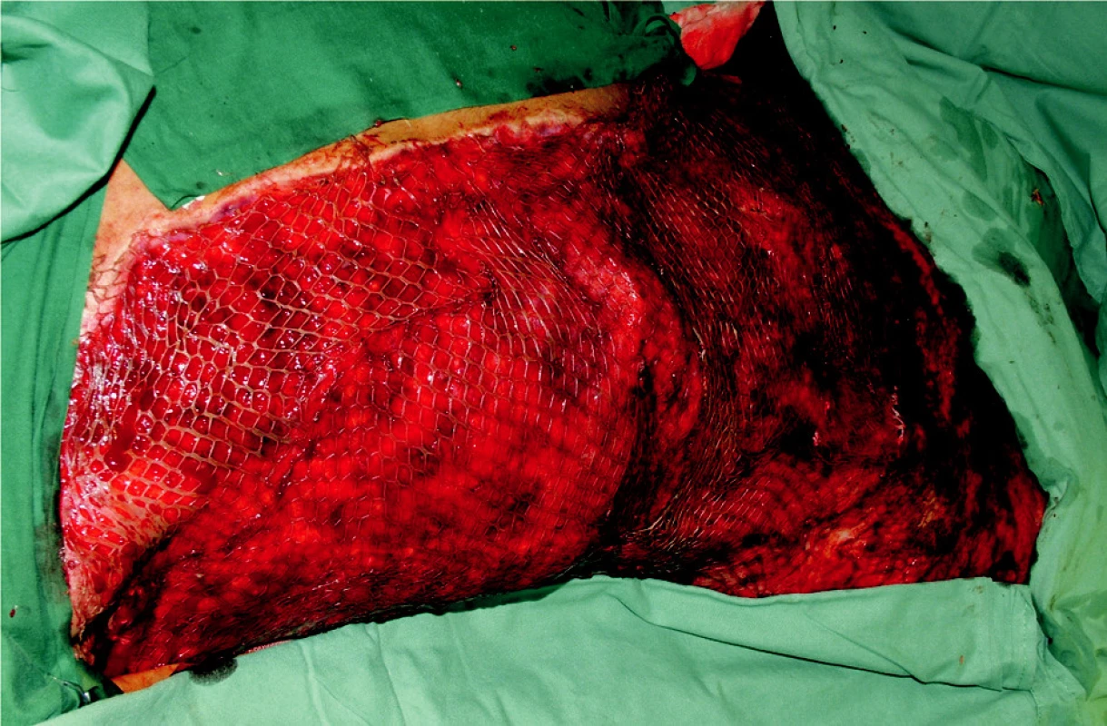 Freshly meshed grafts within the rate of 1:3 placed on trunk