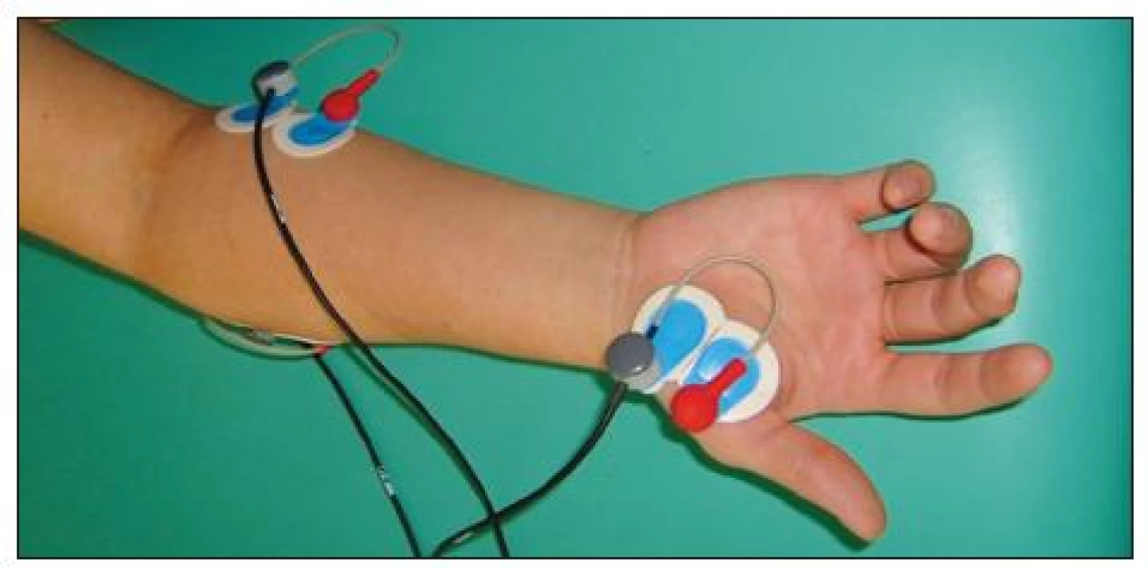Umístění elektrod: m. opponens pollicis, m. flexor carpi ulnaris.
