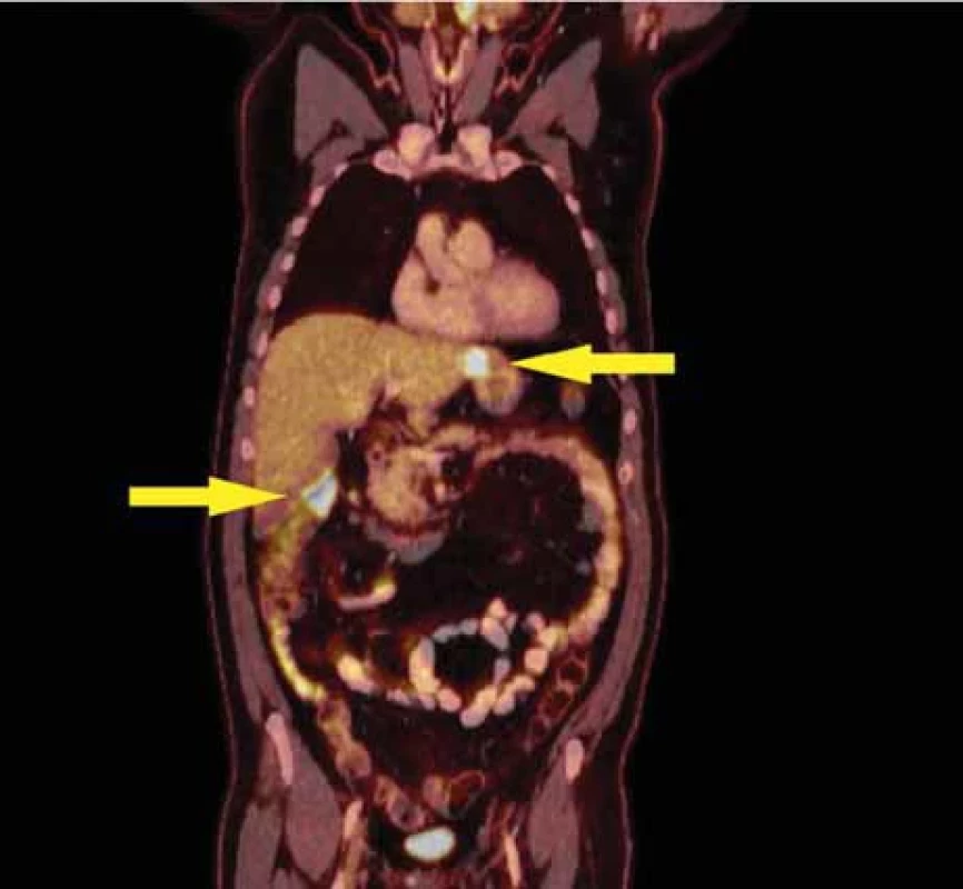 FDG – PET/CT – šipky ukazují viabilní ložisko jater SII a viabilní ložisko vzestupného tračníku.