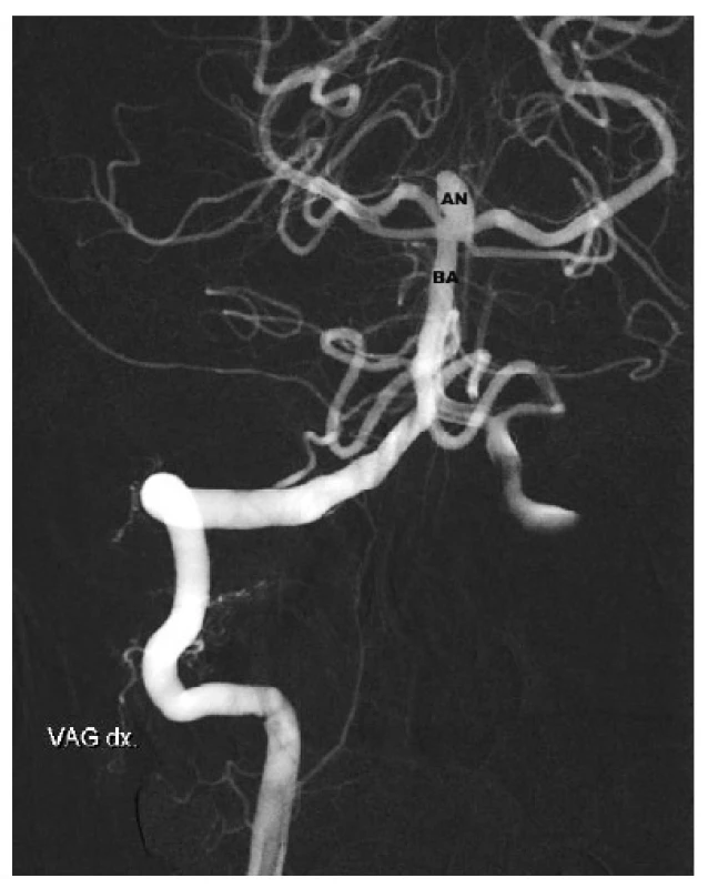 Aneuryzma v terminální části bazilární tepny. AN – Aneuryzm, BA – bazilární tepna
Fig. 5: Basilar tip aneurysma – AN – aneurysm, BA – basilar artery