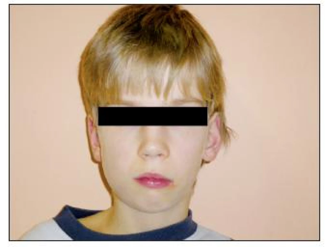 U pacienta již zjevná asymetrie obličeje