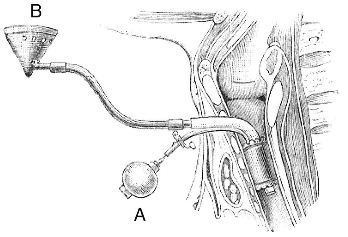 Tracheostomální narkóza z učebnice H. Tillmanns: Lehrbuch
der spezialen Chirurgie 1897 Umístění Trendelenburgovy tamponovací kanyly: a) balonek pro nafouknutí gumové tamponády, b) plechová nálevka pro éter, krytá tkaninou mající po stranách otvory pro výdech.