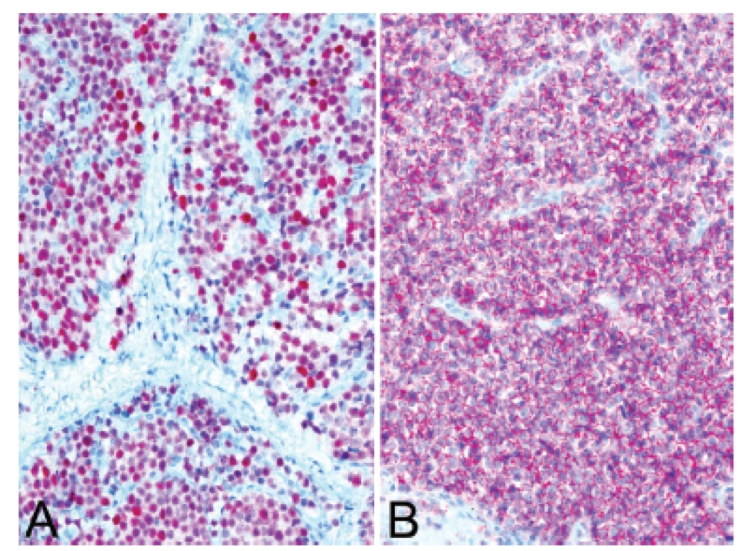 Kazuistika <b>3</b>. Silná a difúzní pozitivita protilátek NKX2.2 (A) a CD99 (B) v kontextu histologického obrazu favorizovala diagnózu Ewingova sarkomu (IHC, 200x).