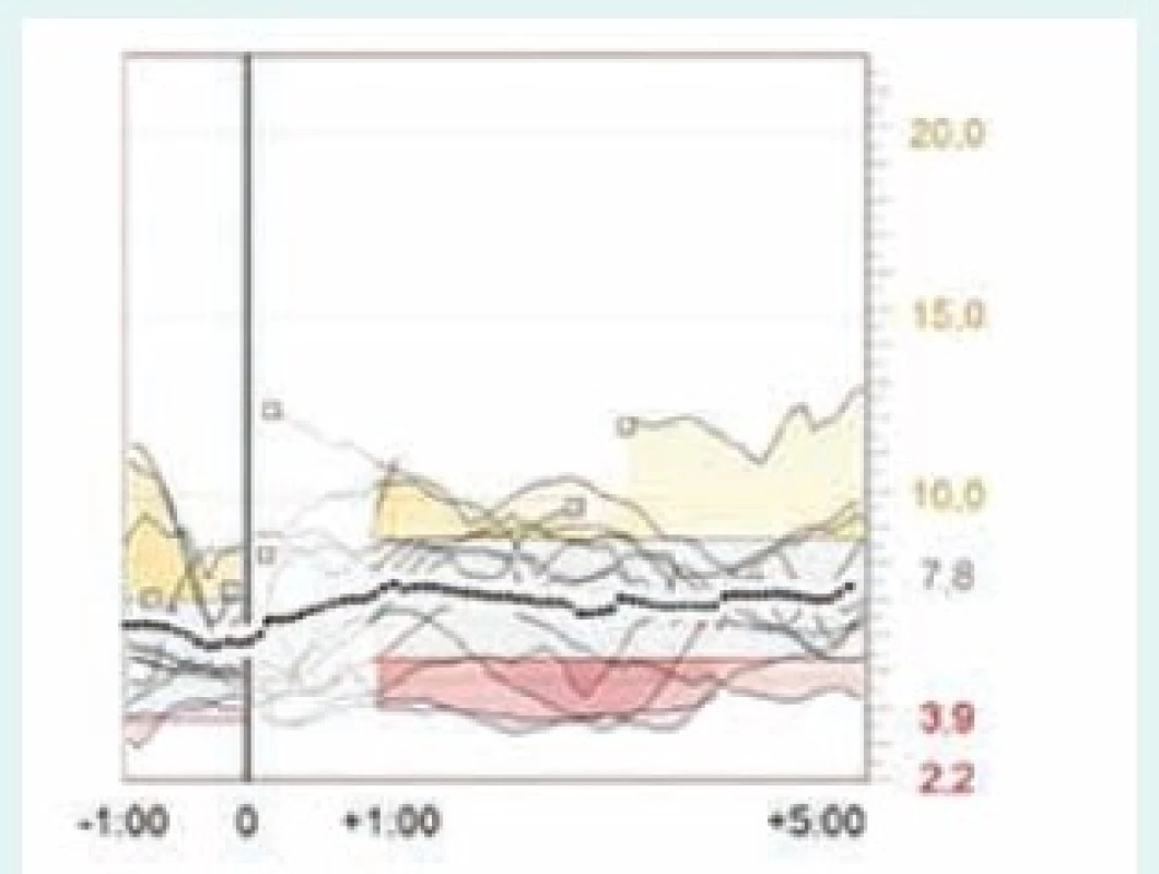 Postprandiální glykemie po večeři u téže pacientky – CGM záznam použití bolusového kalkulátoru. Vodorovná osa ukazuje čas v hodinách, svislá glykemii v mmol/l. Svislá čára v bodě 0 je softwarově synchronizovaný čas aplikace bolusu, který tak udává přibližný začátek jídla. Průměrná dávka inzulinu před večeří je 3,4 j, glykemie před večeří je 6,3 mmol/l a po večeři 7,2 mmol/l – postprandiální vzestup glykemie je méně než 1 mmol/l. Software Carelink Pro (Medtronic).