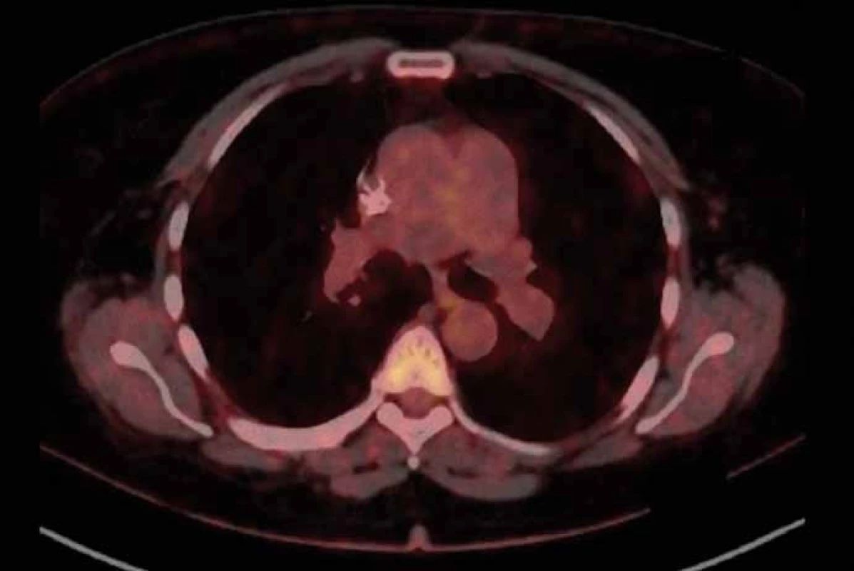 PET/CT z 21. 9. 2015 po dvou měsících léčby crizotinibem.