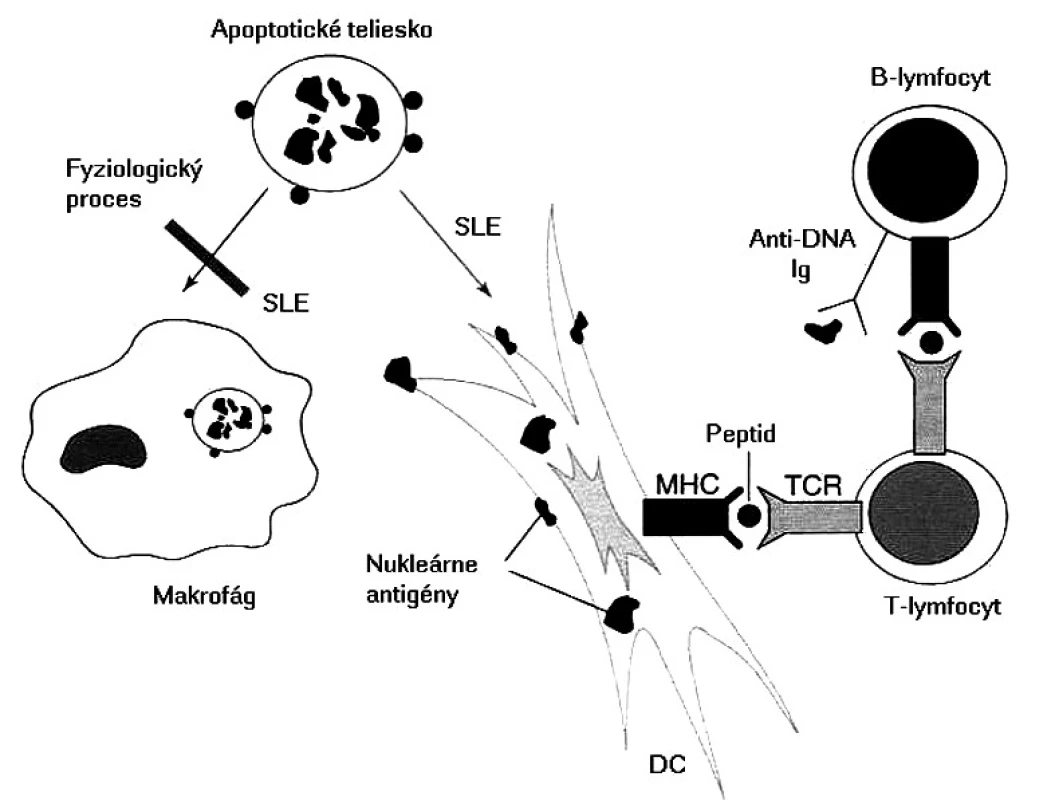 Možný mechanizmus etiopatogenézy pri SLE Pri SLE sa nedostatočne odstraňujú apoptotické telieska, čo umožní dendritovým bunkám vo zvýšenej miere prezentovať nukleárne antigény. Dendritové bunky aktivujú T-lymfocyty, ktoré potom kooperujú s B-lymfocytmi a stimulujú ich, aby produkovali autoprotilátky s následným vývojom zápalových procesov
Fig. 2. Possible etiopathogenetic mechanism of SLE In SLE, apoptotic bodies are not removed sufficiently and consequently, dendritic cells can present nuclear antigenes to a greater extent. Dendritic cells activate T lymphocytes which in turn cooperate with B lymphocytes and stimulate them to produce autoantibodies with subsequent development of inflammatory processes