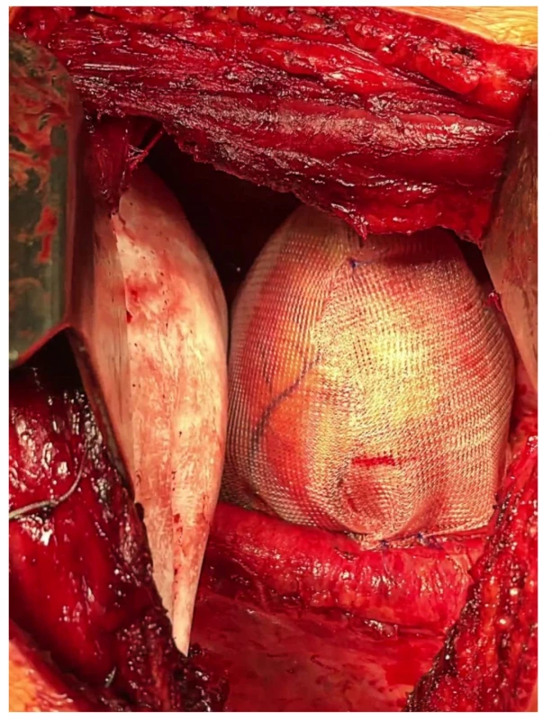 Stav po náhradě bránice záplatou Bard Dulex
Mesh® a perikardu polypropylenovou síťkou<br>
Fig. 3: Condition after replacement of the diaphragm with
a Bard Dulex Mesh® patch and pericardium with a polypropylene
mesh