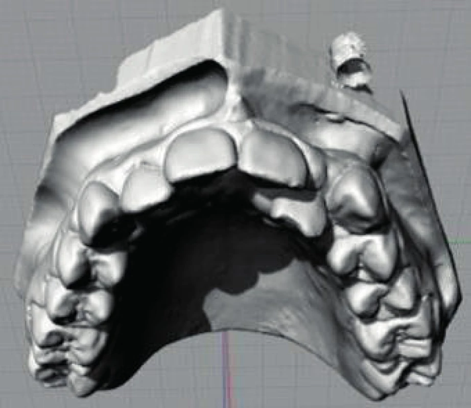Finální digitální model (s laskavým souhlasem MDDr. Kateřiny Mazurové, Ph.D., převzato z: Mazurová, K.: Digitální ortodontické modely. Atestační práce. Olomouc, 2013)
