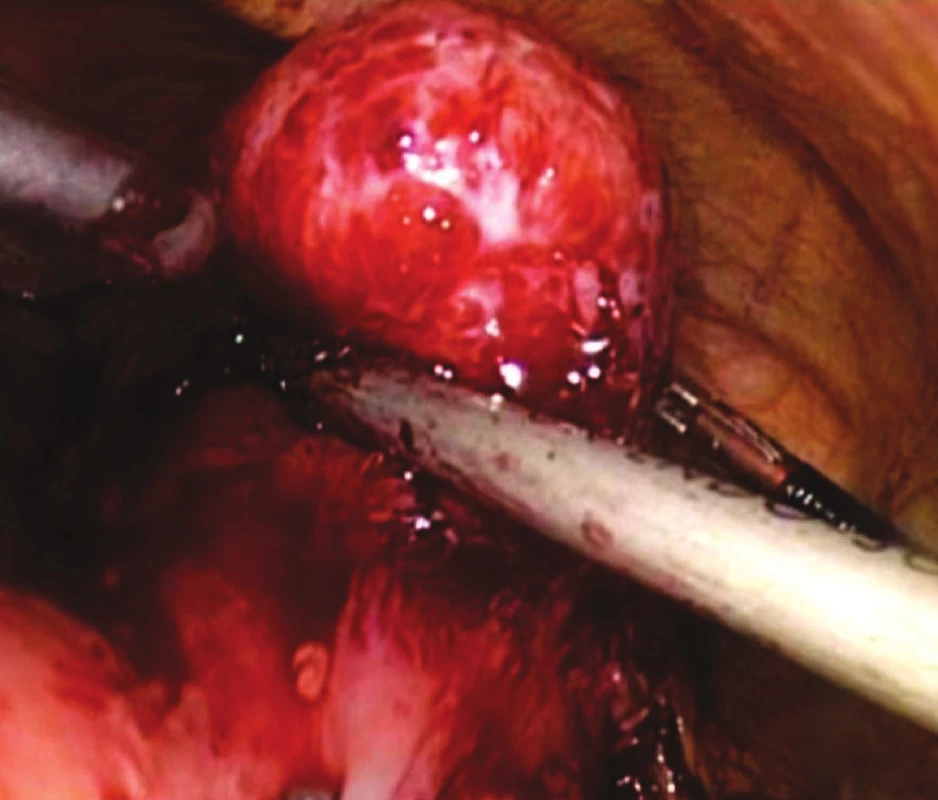 Peroperační snímek GIST žaludku – resekční fáze
Fig. 2. Intraoperative view of gastric GIST – resection phase
