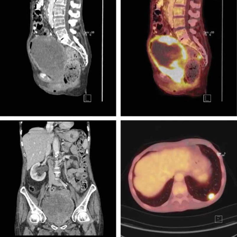FDG-PET/CT scan (due to renal deterioration without iodine contrast i.v. Axial plane, non-contrast CT showing huge urinary bladder mass (A); axial plane, FDG accumulating in tumorous bladder tissue (non-accumulating necrotic inner part of the tumor) (B); coronal plane, obstructed right kidney due to bladder mass (C); FDG accumulation lesion in the lower lobe of the left lung (D).