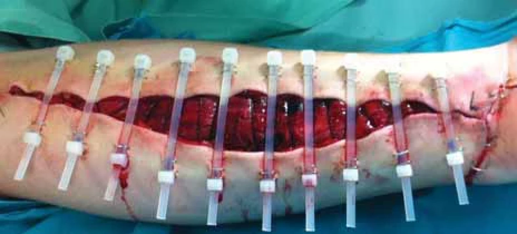 Left forearm fasciotomy wound after application of cable ties plus absorbable barbed suture.