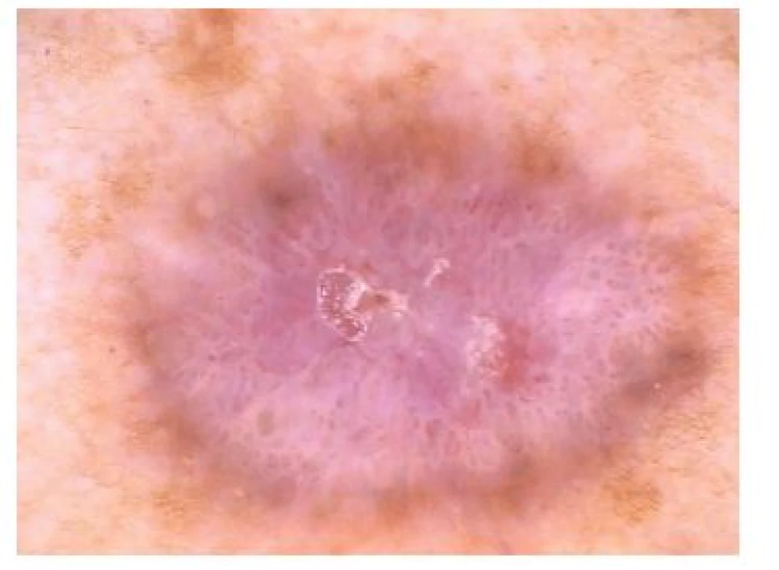 Dermatofibrom