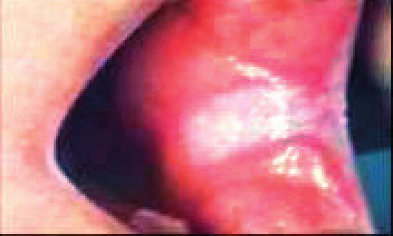 Homogenná leukoplakia na ľavej bukálnej sliznici. Leukoplakický plát začína v ústnom kútiku, vejárovite sa rozširuje distálne a končí na hranici anteriórnej plochy bukálnej sliznice (Ďurovič)