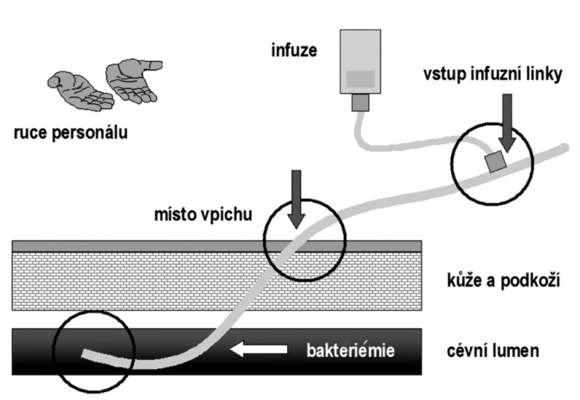 Zdroje kontaminace cévních katétrů