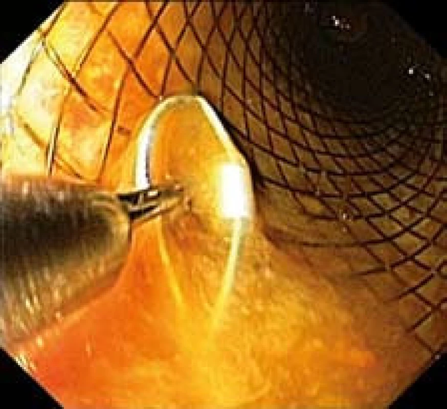 Stent s očkem vývazového lanka pro extrakci zachyceným do extraktoru (endoskopický obraz).
Fig. 11. Stent with a loop of an unbinding cable for extraction, attached to the extractor (endoscopic image).