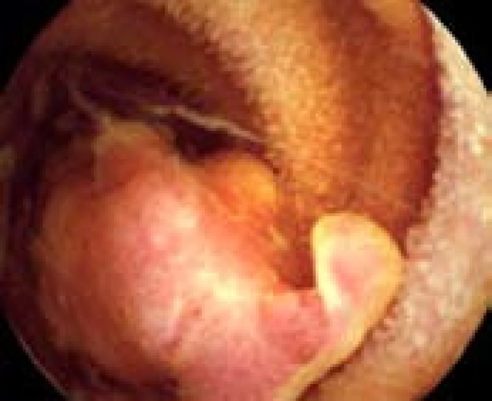Velký zánětlivý polyp v jejunu.
Fig. 3. Large inflammatory polyp in the jejunum.