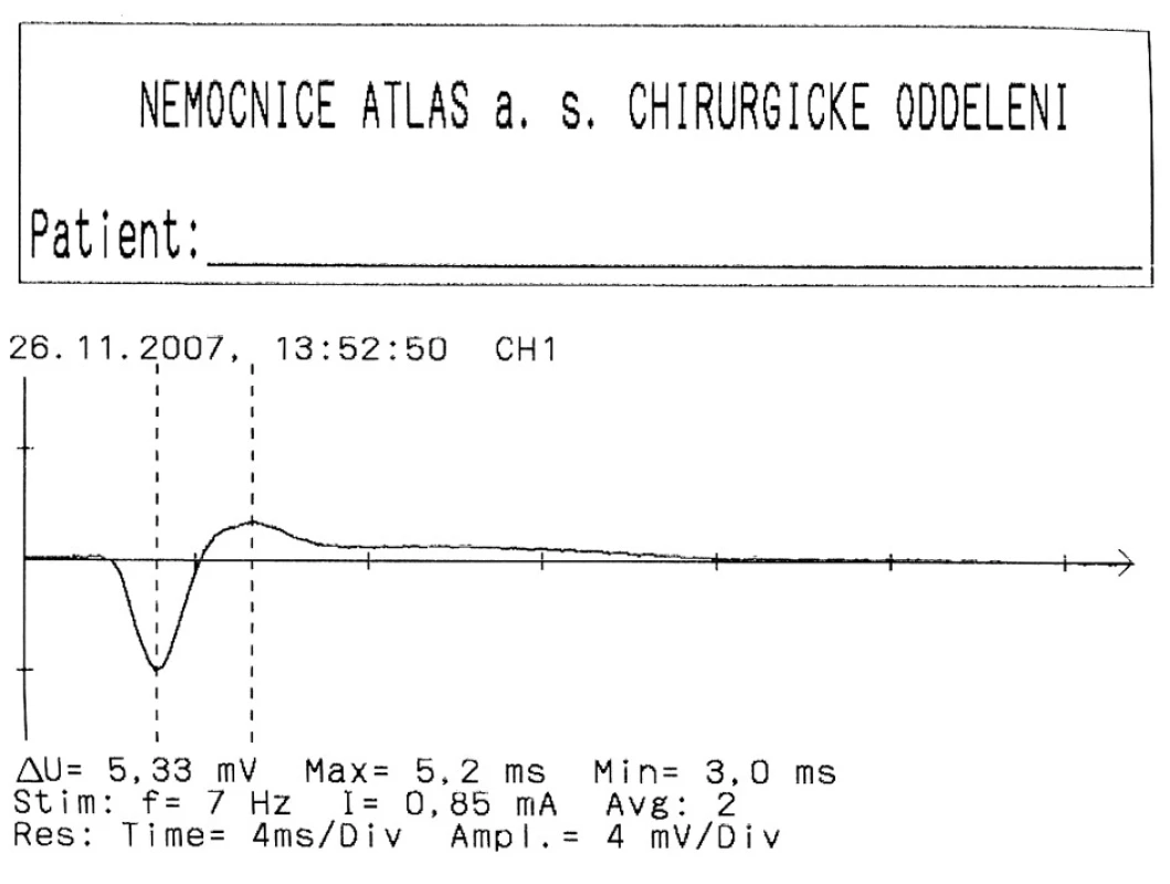 EMG křivka m. vocalis
Fig. 7. The vocal muscle EMG curve 