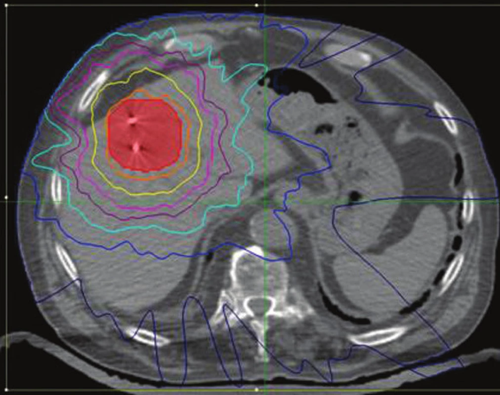 Pacient 2. Stereotaktický plán radioterapie hepatálnych metastáz s implantovanými zlatými zrnami