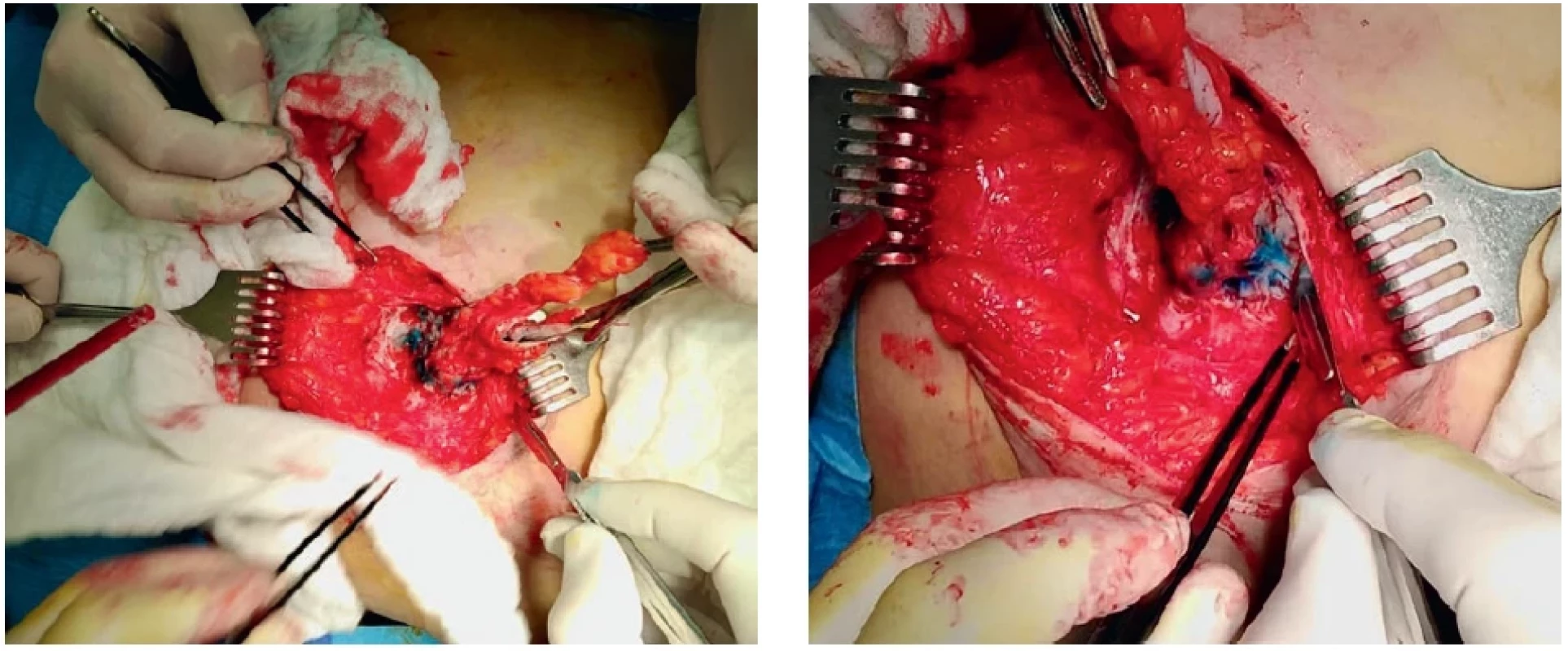 Nástřik píštěle patentní modří, excise jizvy a exstirpace probarvené tkáně a píštěle. Injection of the fistula with patent blue, excision of the scar and extirpation of the stained tissue and the fistula.