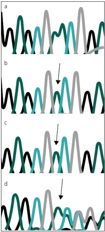 Chromatogram se sekvencí <i>MTM1</i> genu, zobrazující místo mutace c.82delA. 