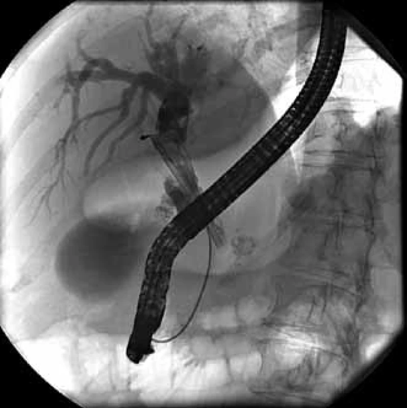 Stenóza distálneho choledochu s prestenotickou dilatáciou, proximálne nad stenózou dislokovaný plastový 10 Fr stent, prítomná choledocholitiáza.
Fig. 1. Stenosis of distal common bile duct with upstream dilation, proximally above stenosis dislocated 10 Fr plastic stent, presence of choledocholithiasis.