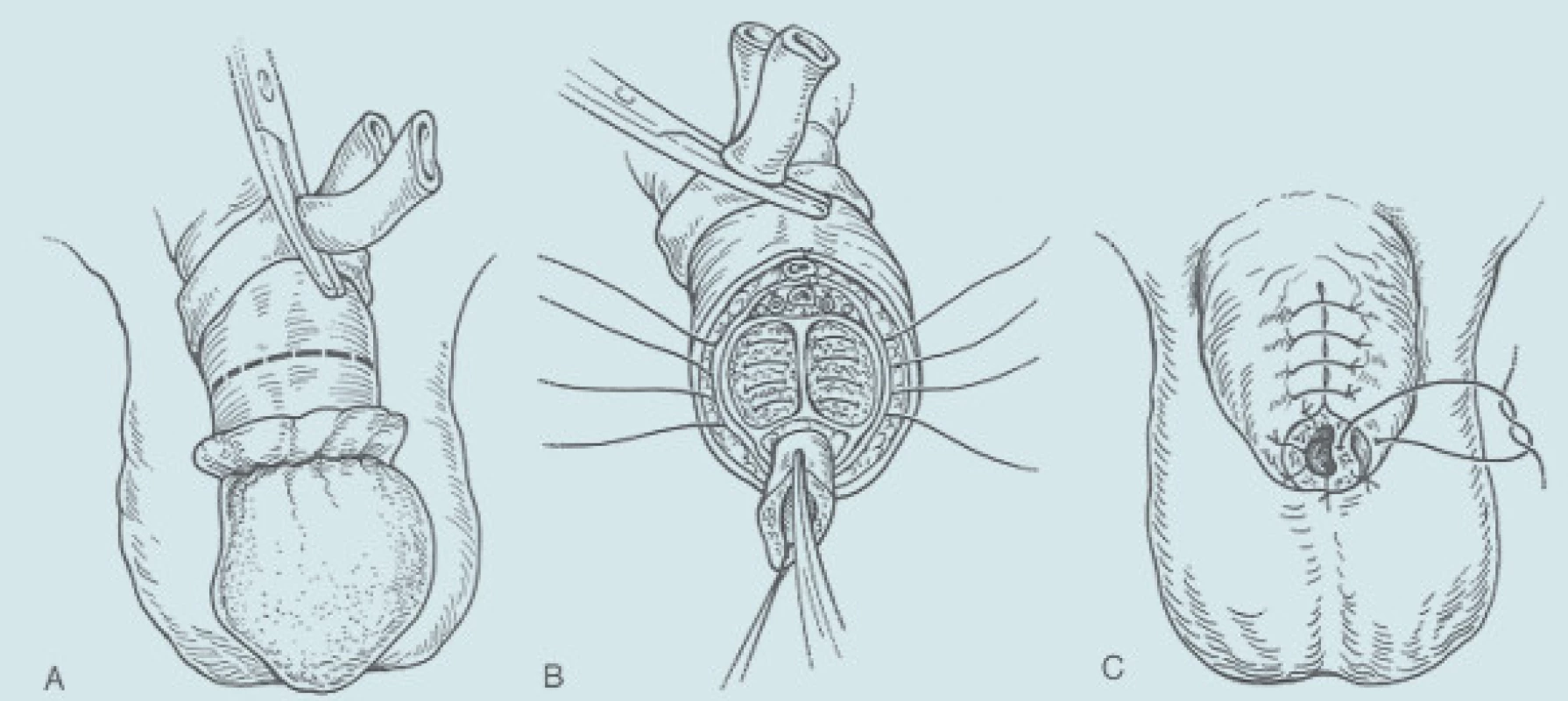 Parciální amputace penisu - klasická technika. A: Naložení turniketu a cirkulární kožní excize 2 cm proximálně od nádorového postižení. B: Gilotinové přerušení kavernózních těles a uzavření jednotlivými matracovými hemostatickými stehy 2-0. Přesahující část uretry je nastřižena, vějířovitě rozevřena a marsupializována ke kožním okrajům. C: uzávěr kožního krytu pahýlu penisu.